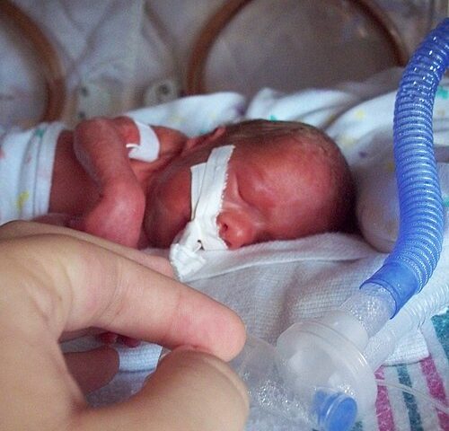 Bebê prematuro em incubadora