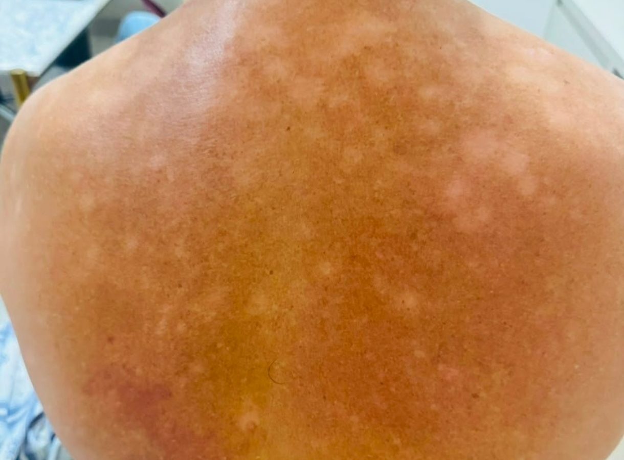 Prefeitura de Cáceres realiza 100 pequenas cirurgias dermatológicas neste fim de semana