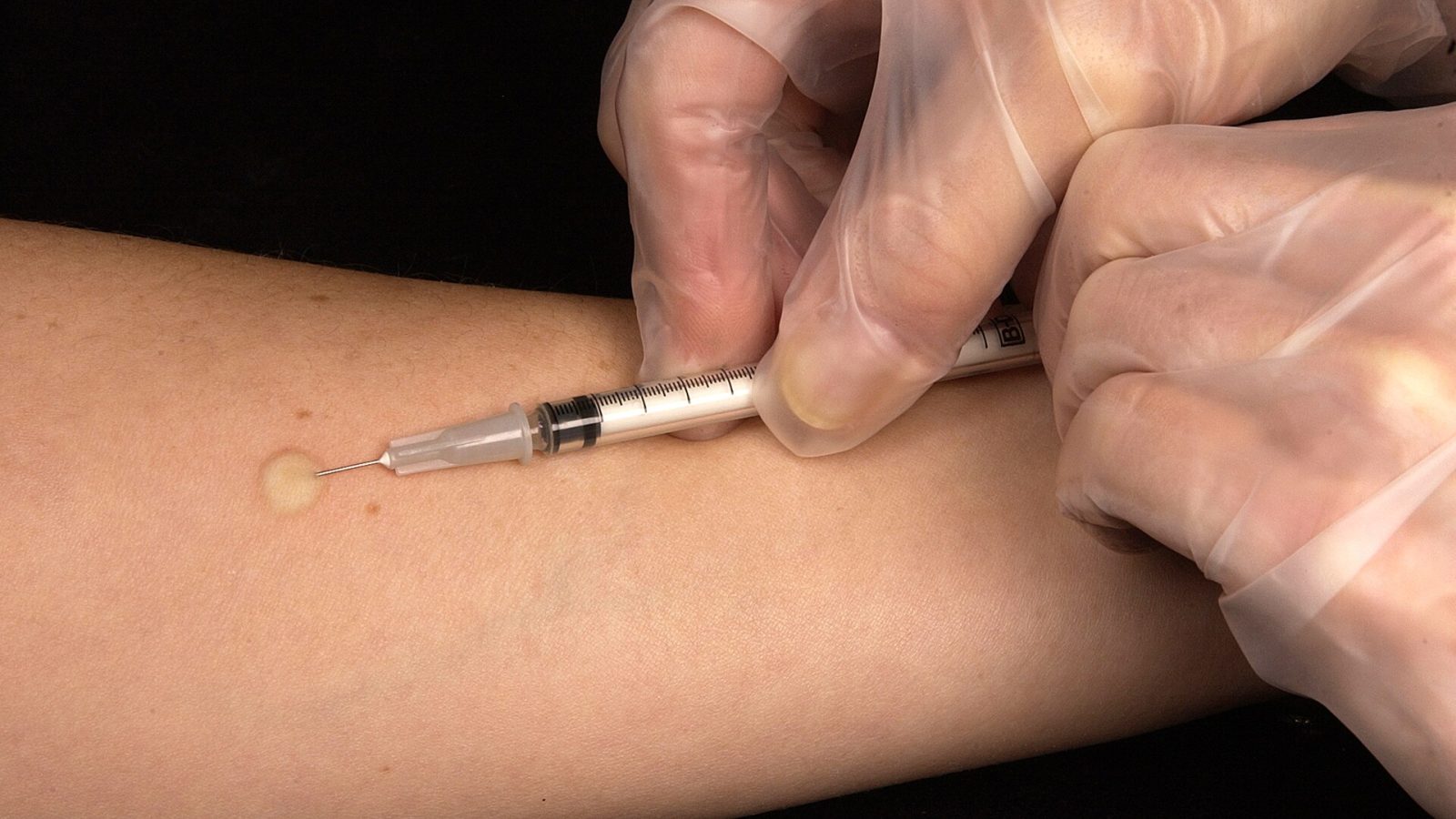 Aplicação de teste tuberculínico no antebraço