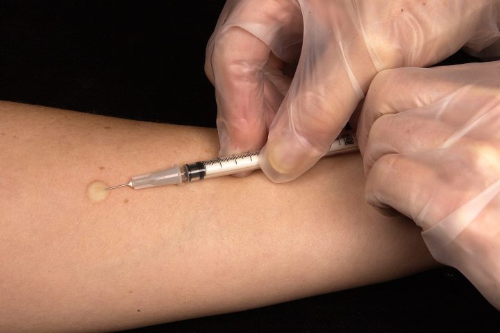 Aplicação de teste tuberculínico no antebraço